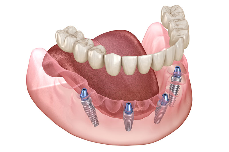 All-on-X Dental Implants in Tucson