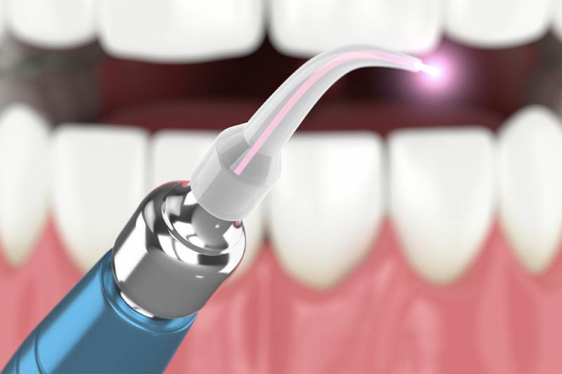Laser Dentistry in Tucson